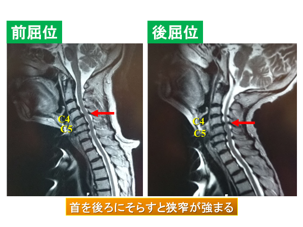 頸レントゲン写真