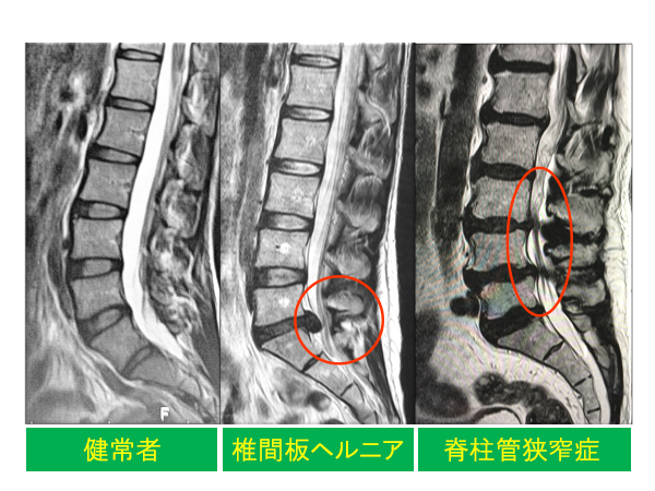 腰レントゲン写真